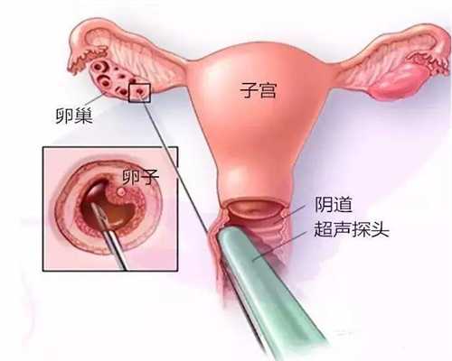 广州代孕小孩-代孕选择哪国比较好_泰国试管婴儿优势包括给胚胎做PGD检查